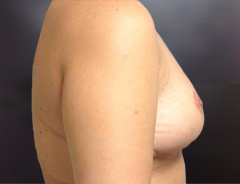 Side Extended Breast Lift, After