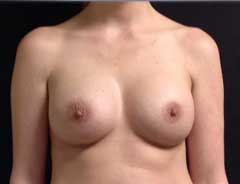 Front View, Breast Augmenation, after
