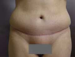 After Skin Only Tummy Tuck Front
