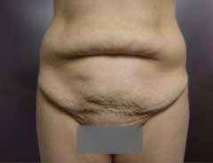 Before Skin Only Tummy Tuck Front
