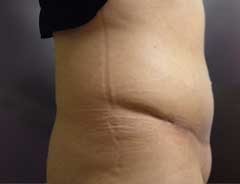 After Skin Only Tummy Tuck Side