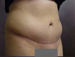 After Skin Only Tummy Tuck Tween
