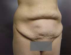 Before Skin Only Tummy Tuck Tween
