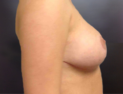 Side View, Breast Reduction, After