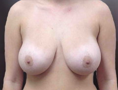 Front view, breast reduction, before