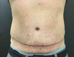 After Skin Only Tummy Tuck Front - male