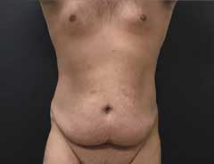 Before Skin Only Tummy Tuck Front - male