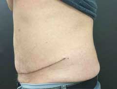 After Skin Only Tummy Tuck Side - male