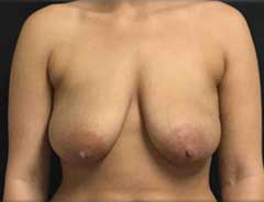 Front view, breast lift, before