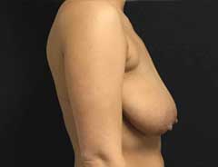 Side view, breast lift, before