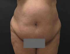 Before Extended Tummy Tuck front