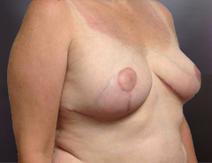Angle view, breast reduction, after