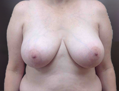 Front view, breast reduction, before