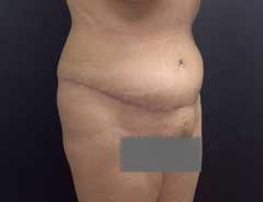 After Extended Tummy Tuck tween