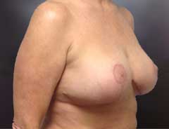 Angle view, breast lift, after