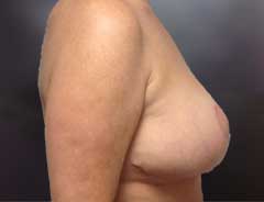 Side view, breast lift, after