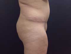 After Extended Tummy Tuck side