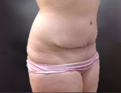 Full Tummy tuck after angle