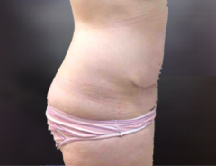 Full Tummy tuck after side