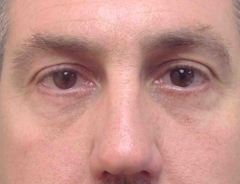 Lower blepharoplasty, after