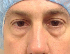 Lower blepharoplasty, before