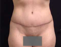 Front view, tummy tuck full, after