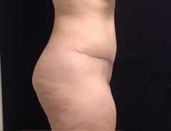 Side view, tummy tuck full, after