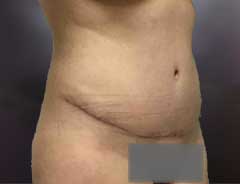 Angle view, tummy tuck full, after
