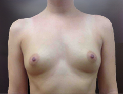 Front view, before breast augmentation: 34B