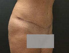 Tummy Tuck, Full, Angle, After