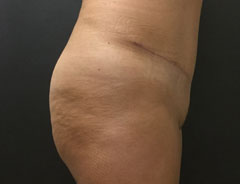 Tummy Tuck, Full, Side, After