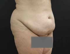 Angle view, tummy tuck extended, before