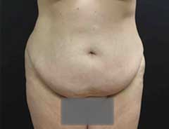Front view, tummy tuck extended, before