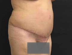Angle view, tummy tuck extended, after