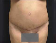 Front view, tummy tuck extended, after