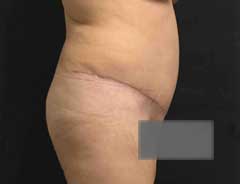 Side view, tummy tuck extended, after