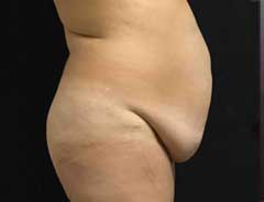 Side view, tummy tuck extended, before