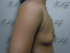 Profile before breast augmentation: 34B