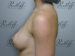 Profile before breast augmentation: 34B