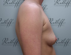 Profile before breast augmentation: 36A