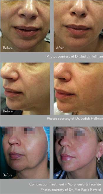 Morpheus8 Rf Microneedling Tulsa Ok Dr Greg Ratliff