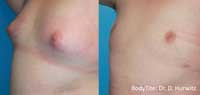 Male breast reduction before and after