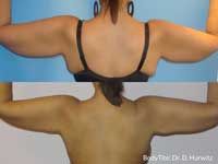 Arm tightening before and after