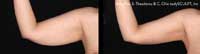 Arm tightening before and after