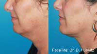 Facetite Before and After