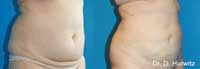 Abdomen Contraction before and after images