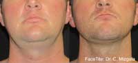 Facetite Before and After