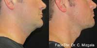 Facetite Before and After