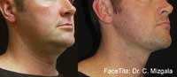 Facetite Before and After