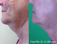 Facetite Before and After